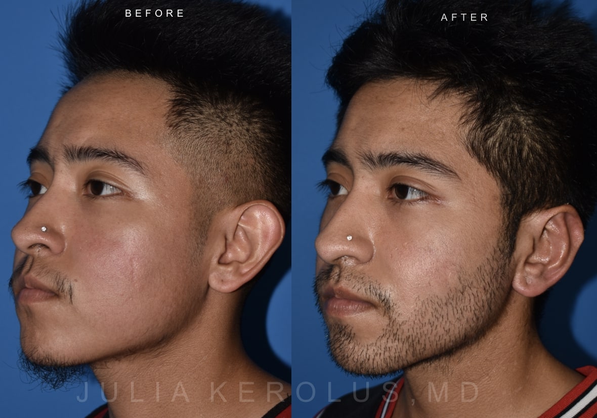 Facial Contouring Before & After Image