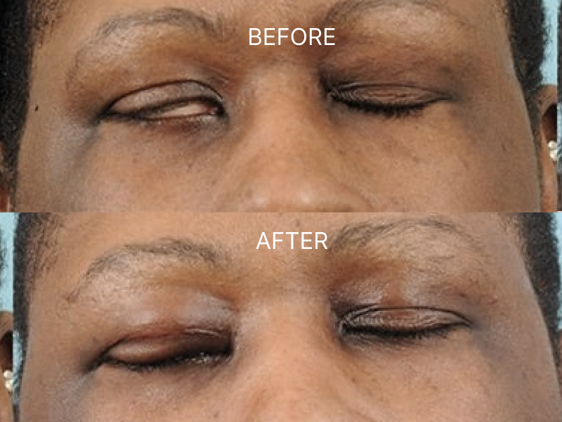 Reanimation Surgery Before & After Image