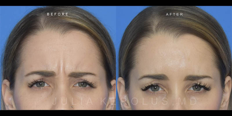 Neuromodulators (Botox/Dysport/Daxxify) Before & After Image