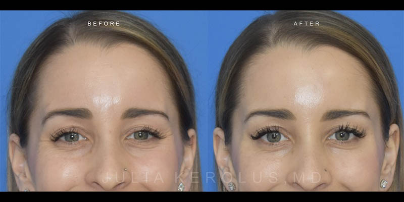 Neuromodulators (Botox/Dysport/Daxxify) Before & After Image