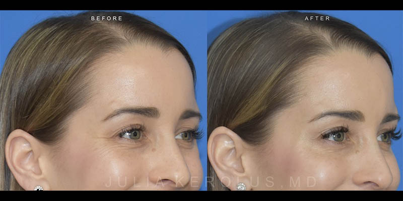Neuromodulators (Botox/Dysport/Daxxify) Before & After Image