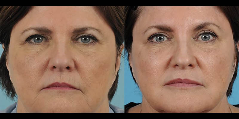 Neuromodulators (Botox/Dysport/Daxxify) Before & After Image