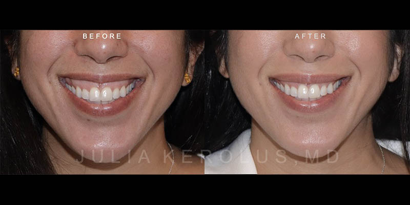 Neuromodulators (Botox/Dysport/Daxxify) Before & After Image