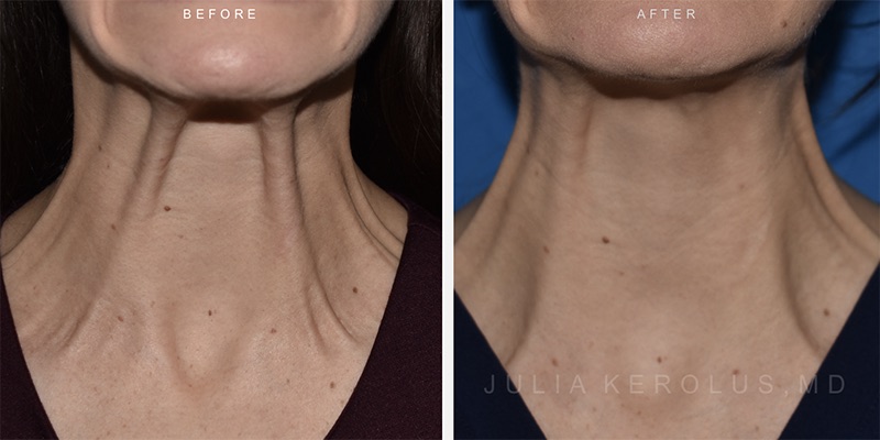 Neuromodulators (Botox/Dysport/Daxxify) Before & After Image