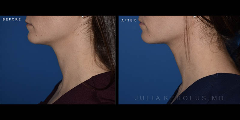 Neuromodulators (Botox/Dysport/Daxxify) Before & After Image