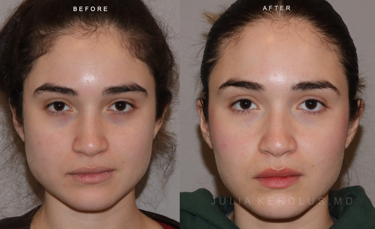 Neuromodulators (Botox/Dysport/Daxxify) Before & After Image