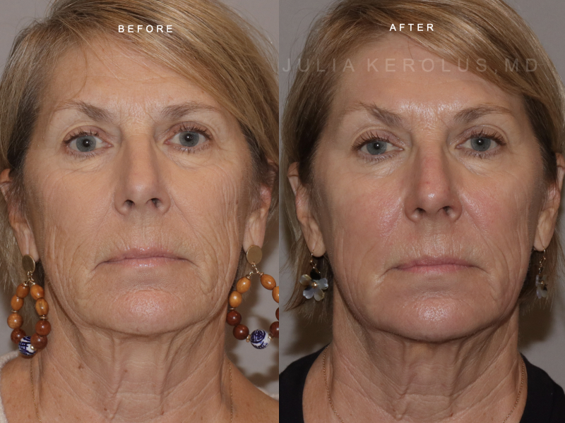 CO2 Laser Before & After Image