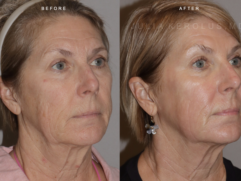 CO2 Laser Before & After Image