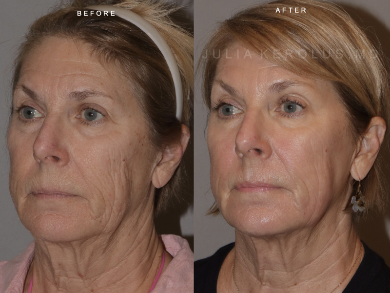 CO2 Laser Before & After Image