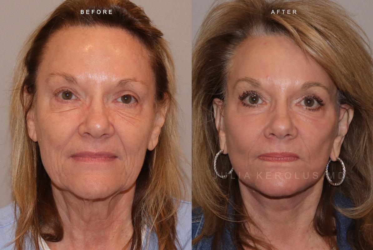 CO2 Laser Before & After Image