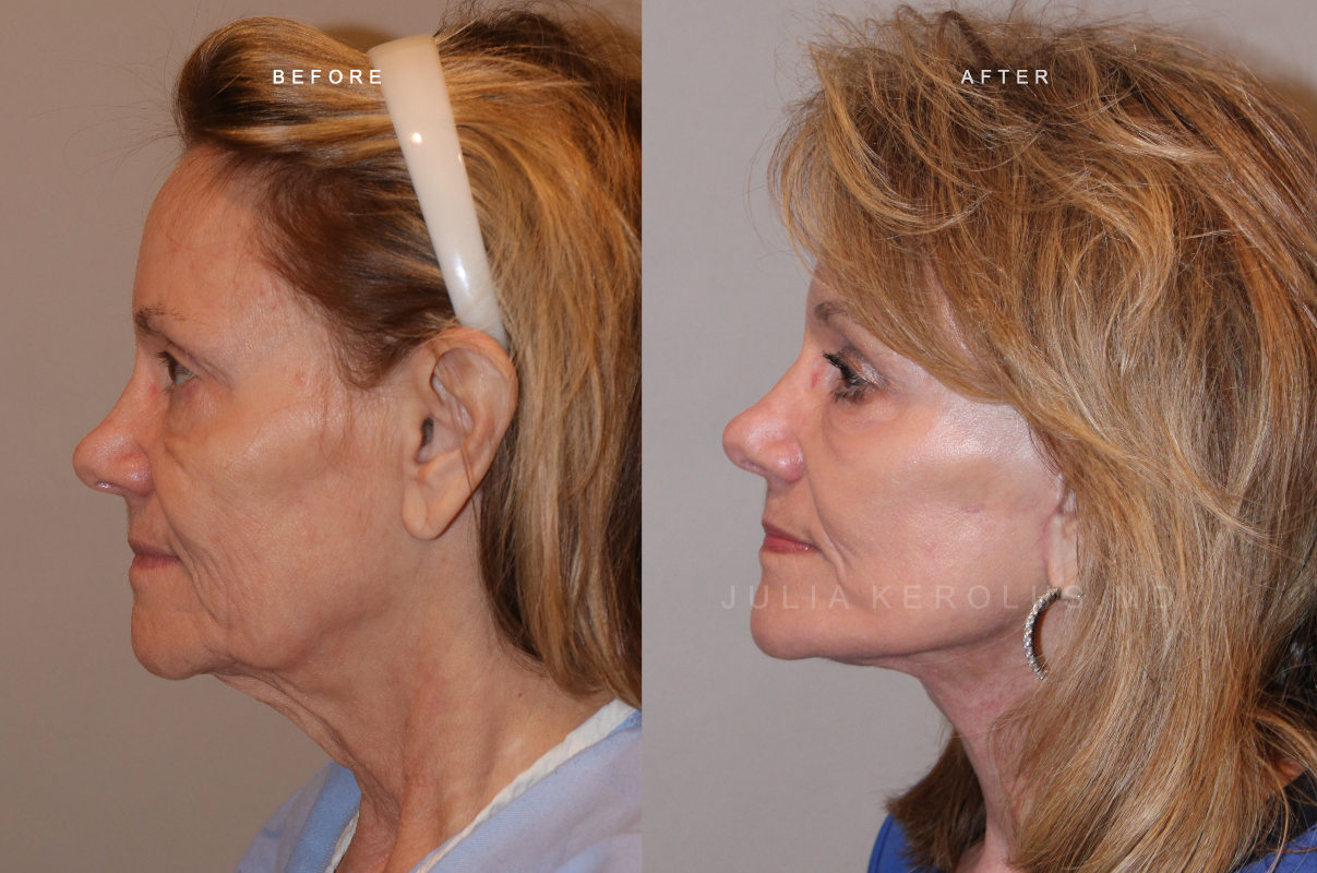 CO2 Laser Before & After Image