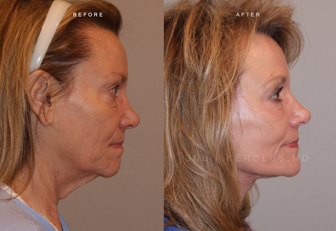 CO2 Laser Before & After Image