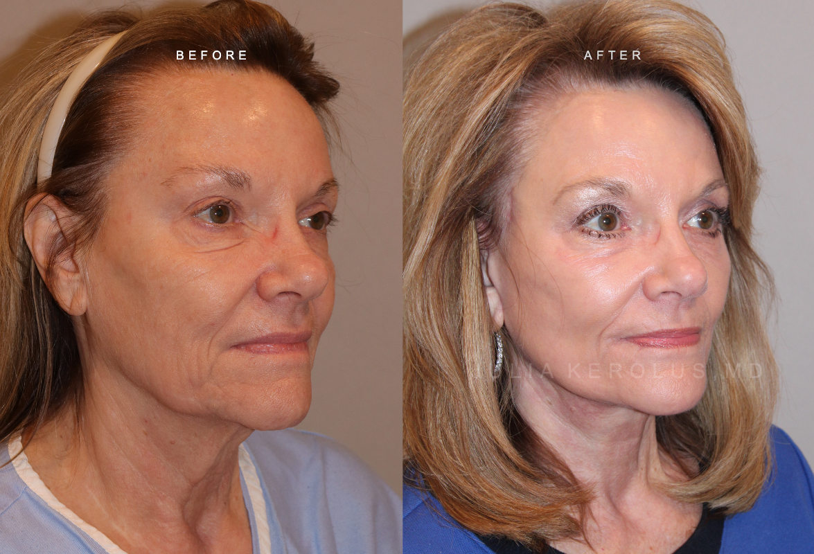 CO2 Laser Before & After Image