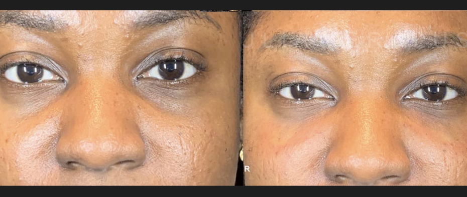 Dermal Fillers Before & After Image