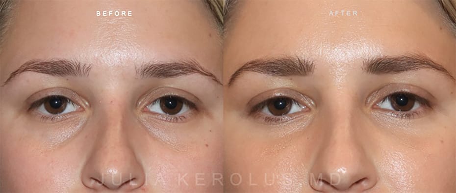 Dermal Fillers Before & After Image