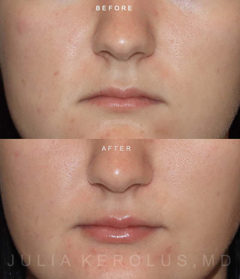 Lip Fillers Before & After Image