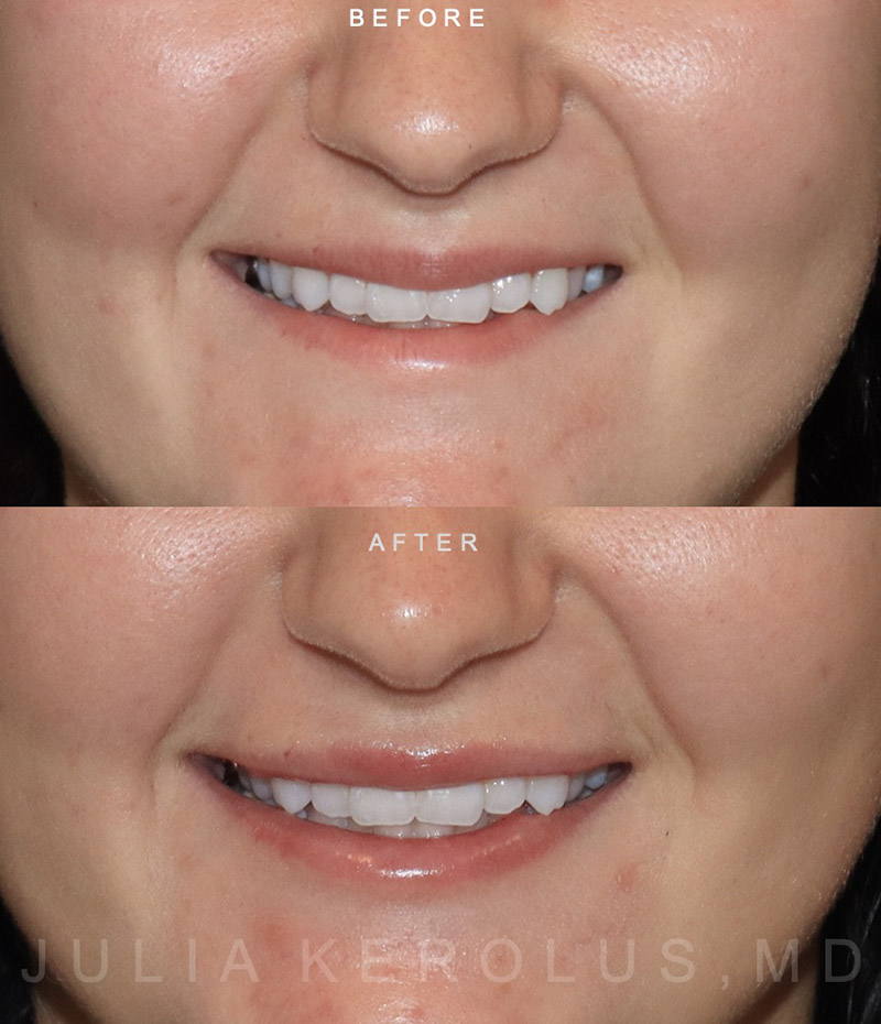 Lip Fillers Before & After Image