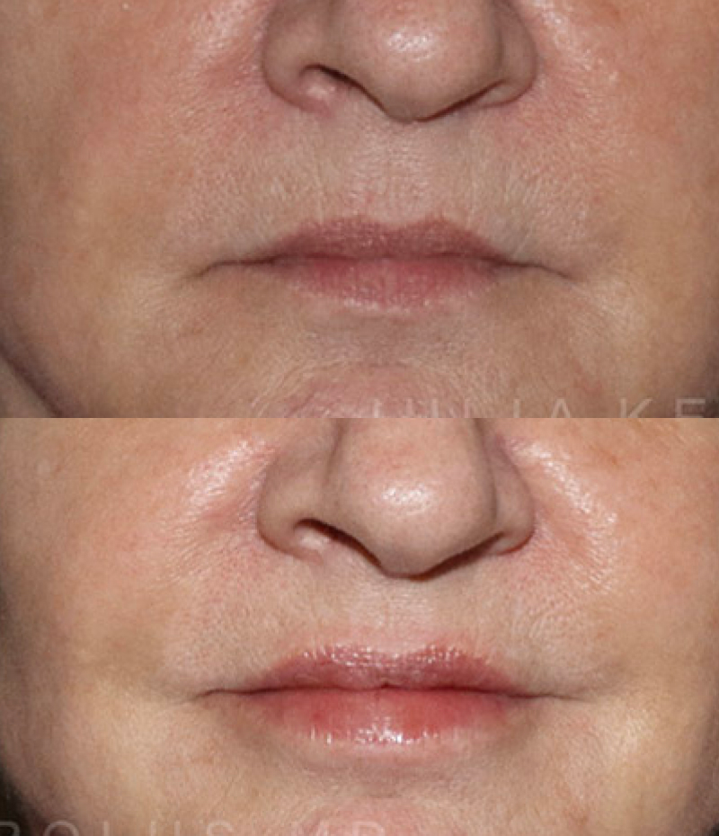 Lip Fillers Before & After Image