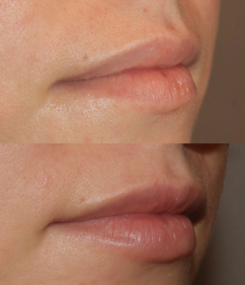 Lip Fillers Before & After Image