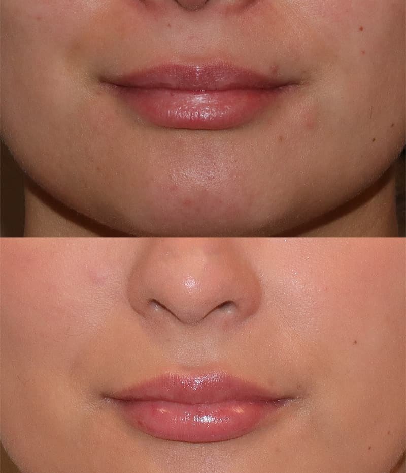 Lip Fillers Before & After Image