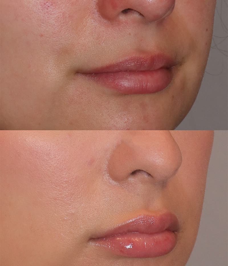 Lip Fillers Before & After Image