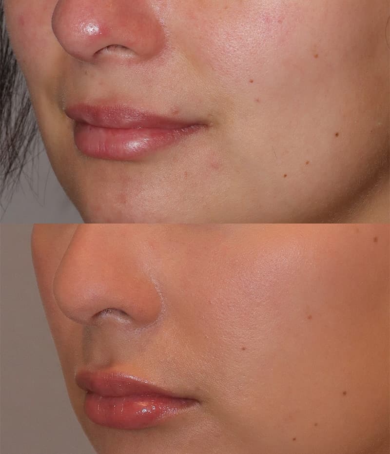 Lip Fillers Before & After Image