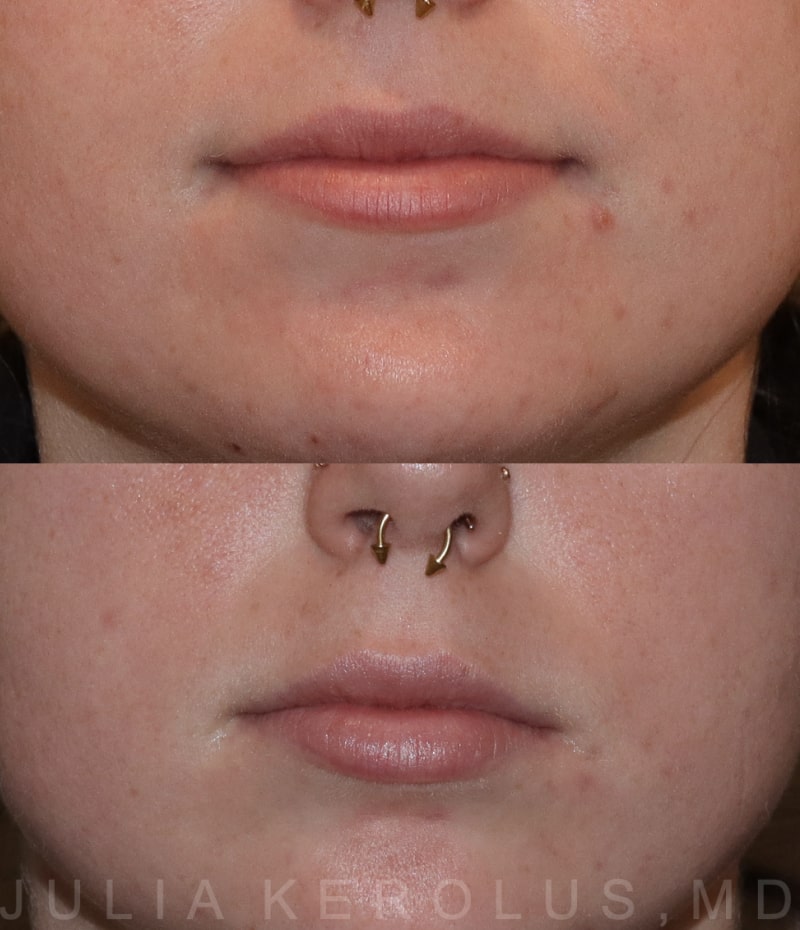 Lip Fillers Before & After Image