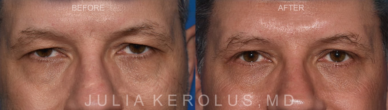 Browlift/Blepharoplasty Before & After Image