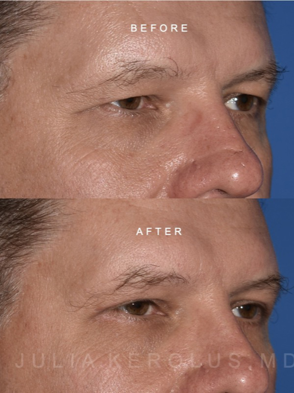 Blepharoplasty Before & After Image