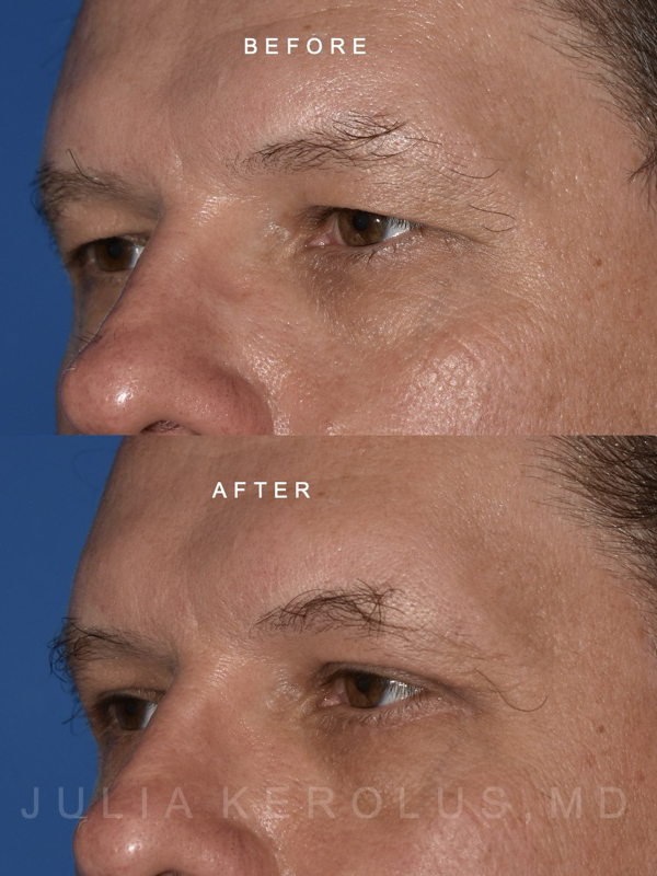 Browlift/Blepharoplasty Before & After Image