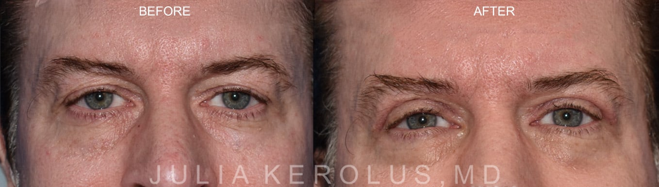 Browlift/Blepharoplasty Before & After Image