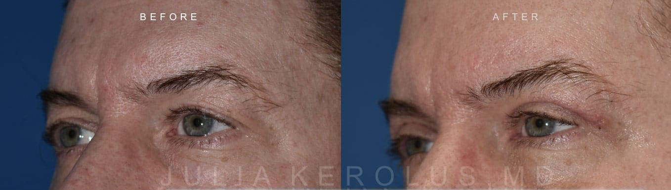 Browlift/Blepharoplasty Before & After Image