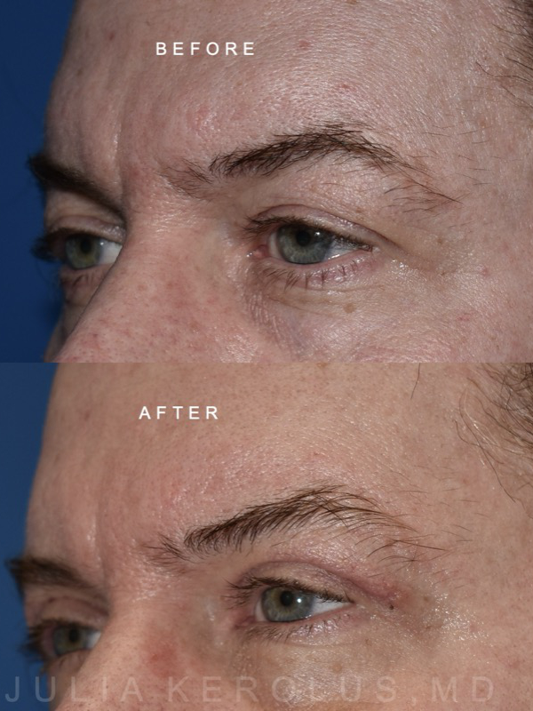 Browlift/Blepharoplasty Before & After Image