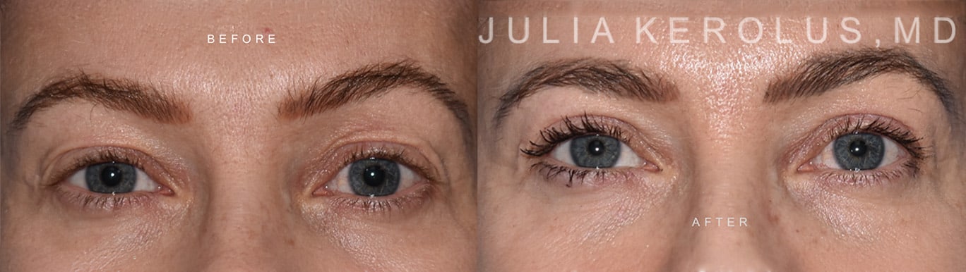 Browlift/Blepharoplasty Before & After Image