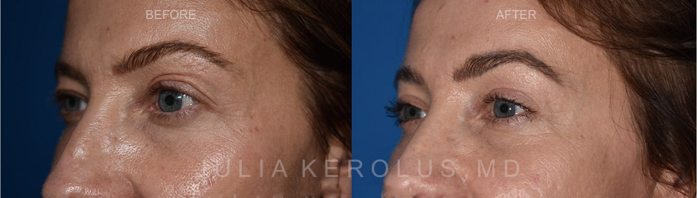 Browlift/Blepharoplasty Before & After Image
