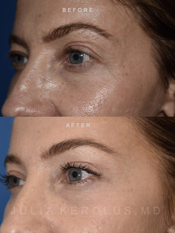 Browlift/Blepharoplasty Before & After Image