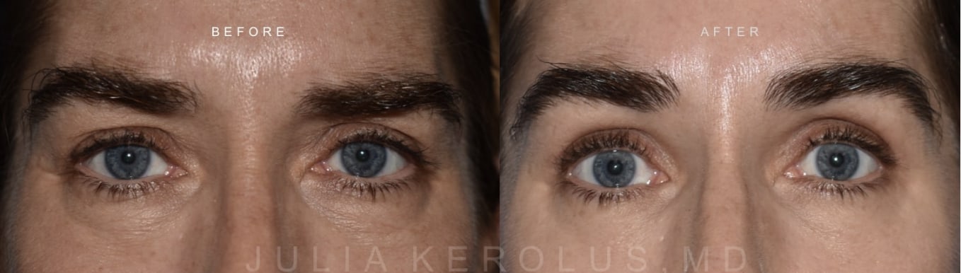 Browlift/Blepharoplasty Before & After Image