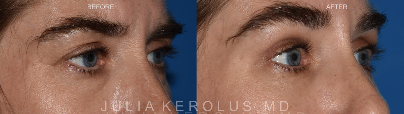 Browlift/Blepharoplasty Before & After Image