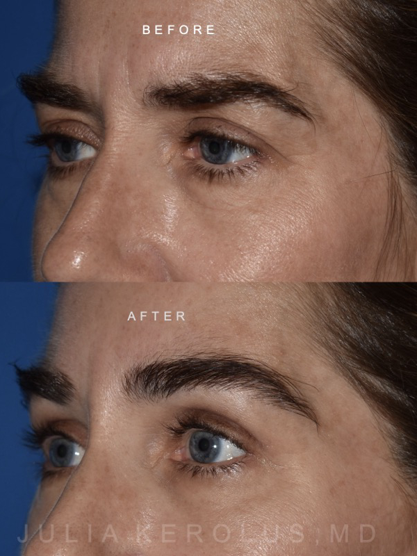 Browlift/Blepharoplasty Before & After Image