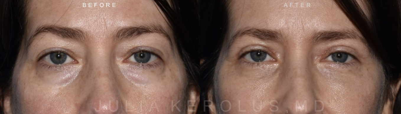 Browlift/Blepharoplasty Before & After Image