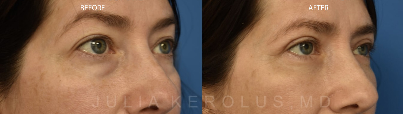 Browlift/Blepharoplasty Before & After Image