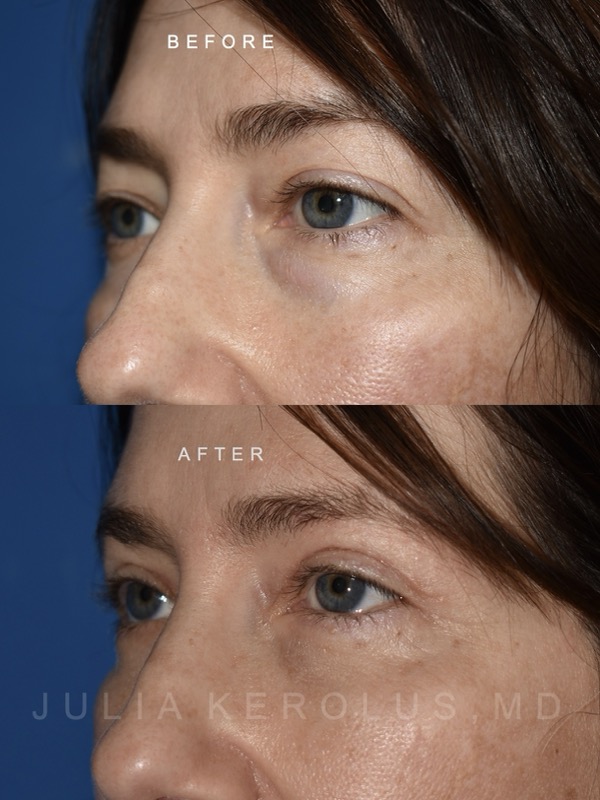 Browlift/Blepharoplasty Before & After Image