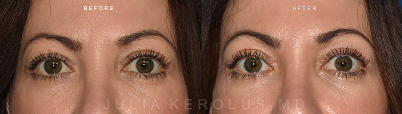 Browlift/Blepharoplasty Before & After Image