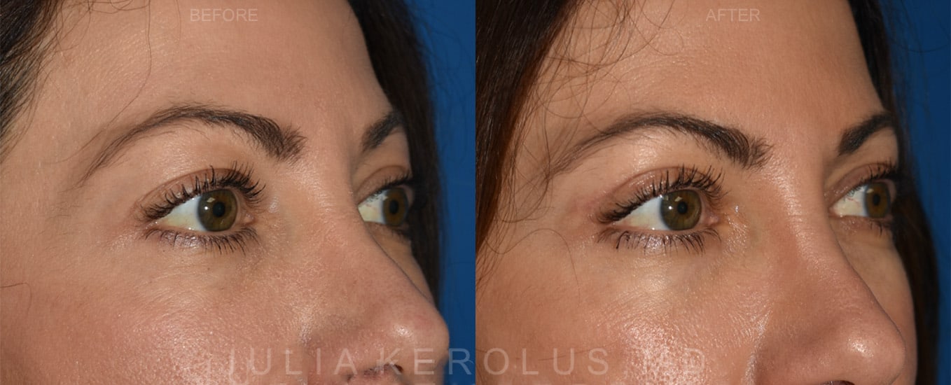 Browlift/Blepharoplasty Before & After Image