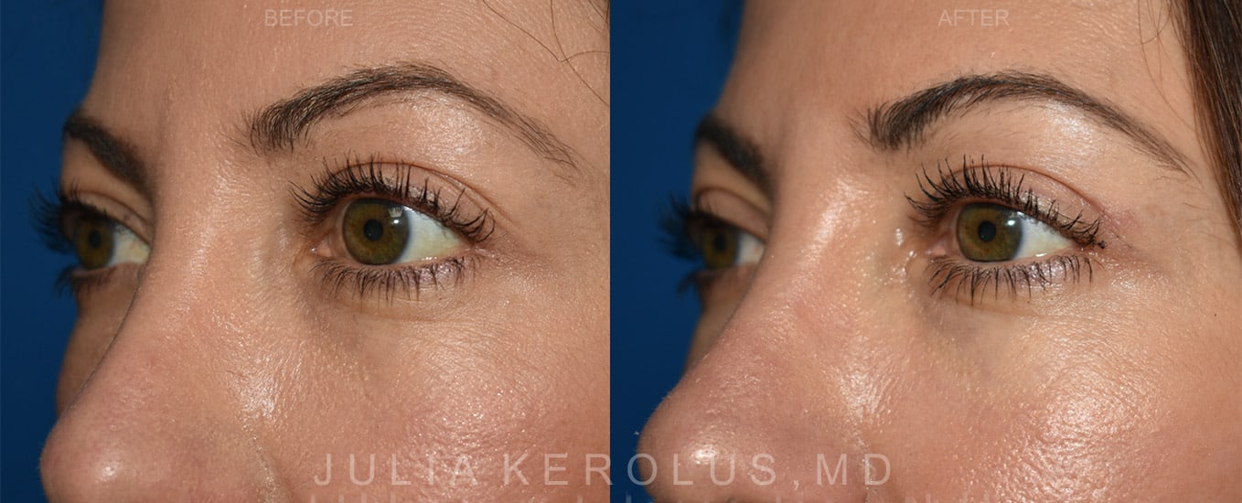 Browlift/Blepharoplasty Before & After Image