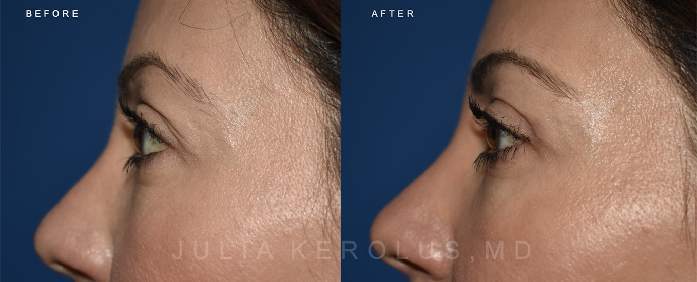 Browlift/Blepharoplasty Before & After Image