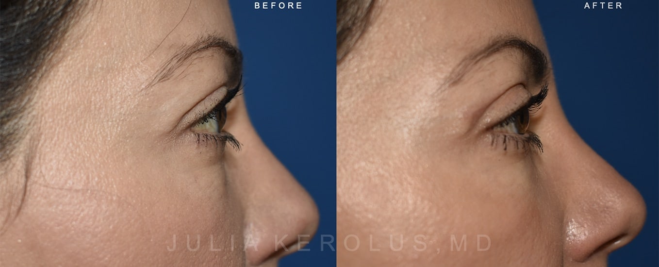 Browlift/Blepharoplasty Before & After Image
