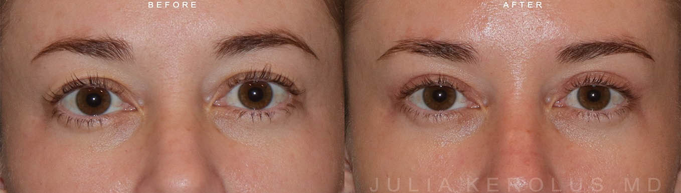 Browlift/Blepharoplasty Before & After Image