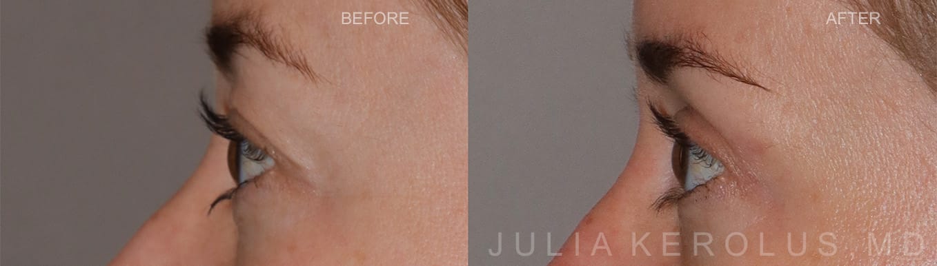 Browlift/Blepharoplasty Before & After Image