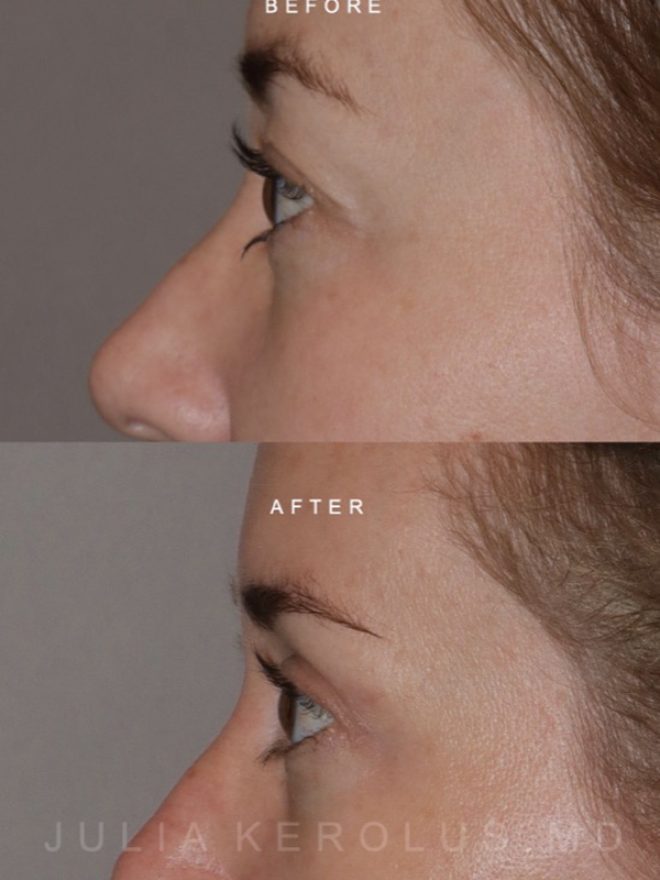 Browlift/Blepharoplasty Before & After Image